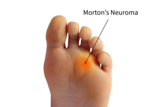 Morton's Neuroma